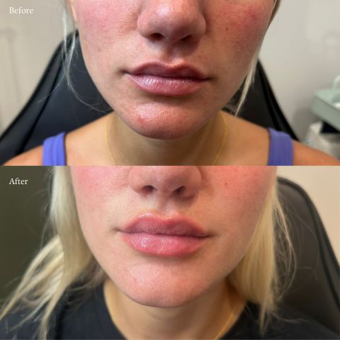 Lip Filler